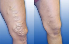 Варикозное расширение вен на ногах: симптомы и лечение, фото